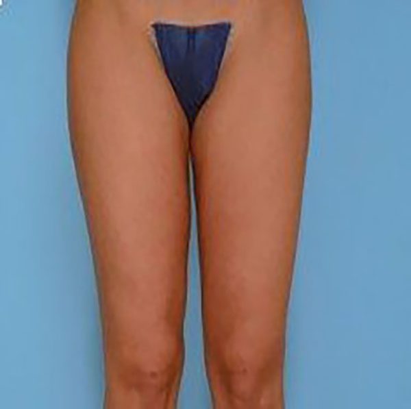 Pubic Lift and Pubic Liposuction in New York & New Jersey