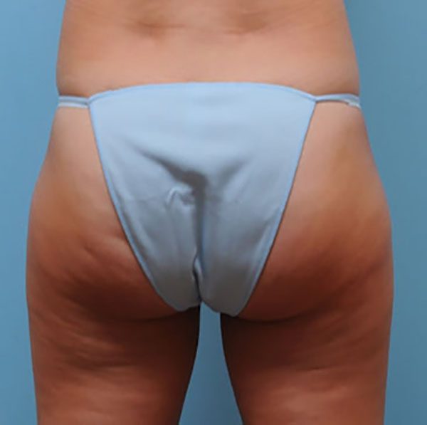 Pubic Lift and Pubic Liposuction in New York & New Jersey