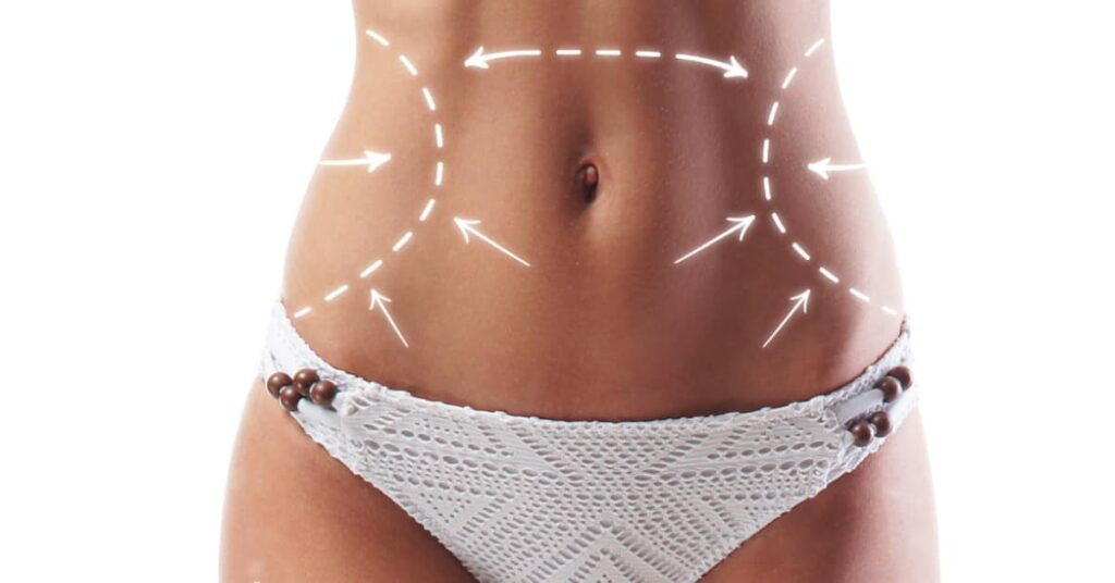 Tummy Tuck Surgery Procedure Overview Before & After
