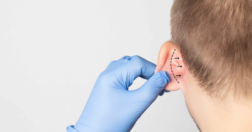 what to you do if you hate your ears, otoplasty