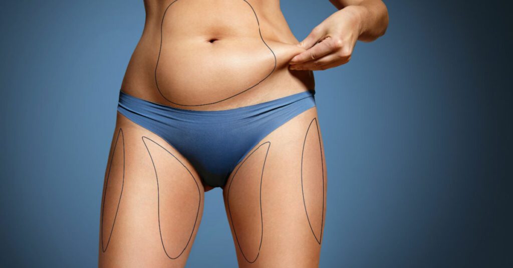 Liposuction or Tummy Tuck